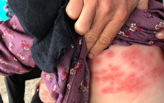 Samos Refugee Scabies